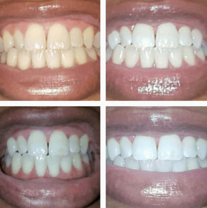 Stylo Blanchissant Instantané