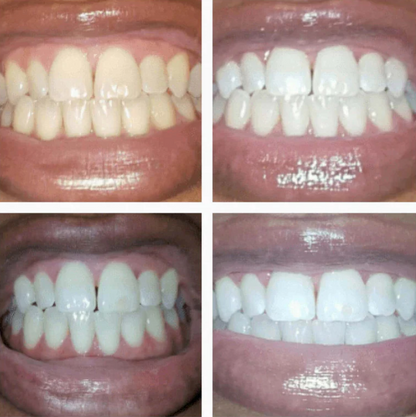 Stylo Blanchissant Instantané